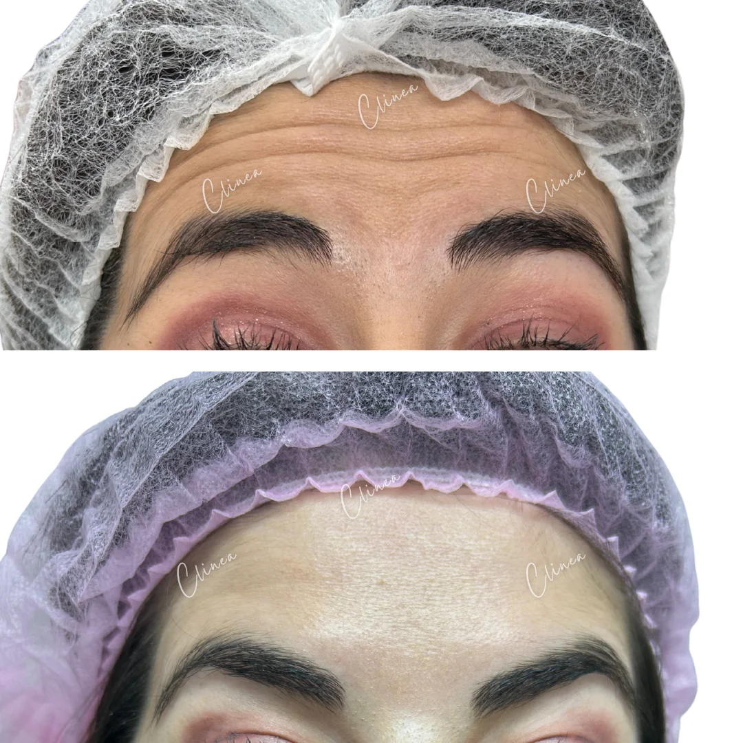 Antes y después de botox en entrecejo, Cali