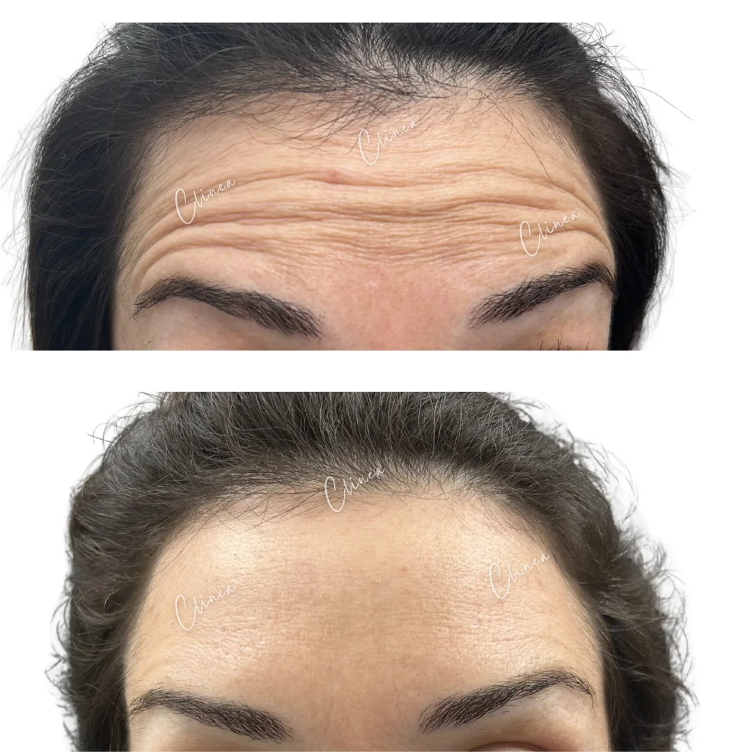 Antes y después de botox en líneas de la frente, Cali