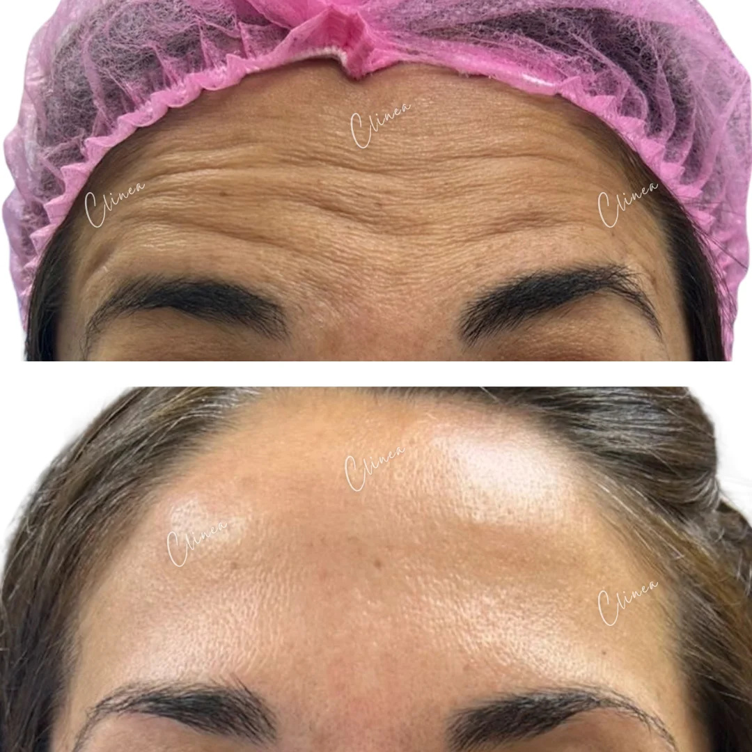 Antes y después de botox en frente, Cali